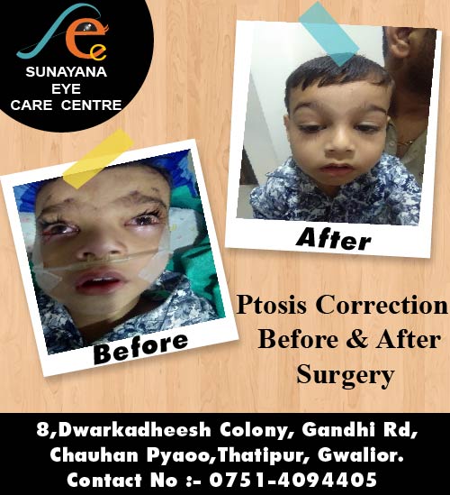 eye before and after 2-01